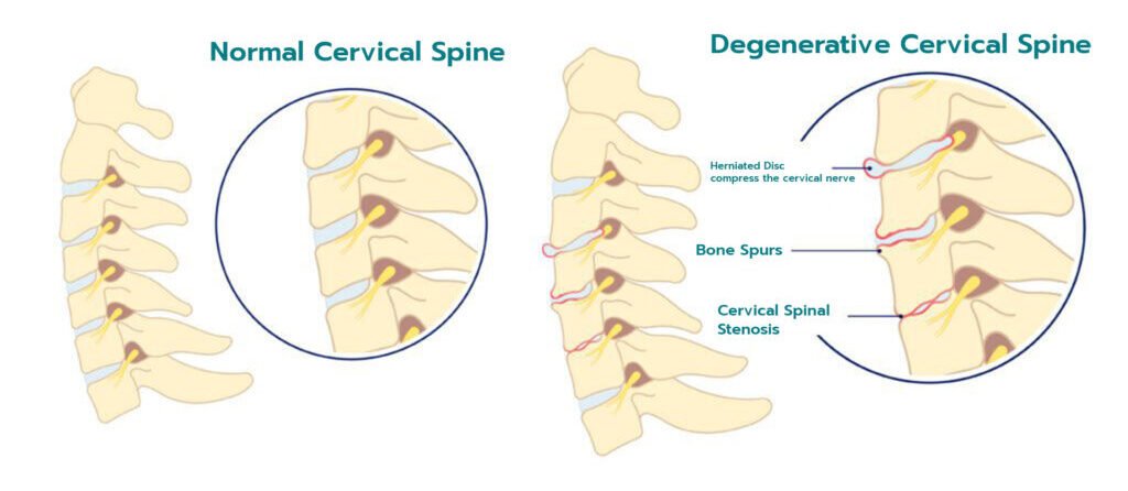 cervical