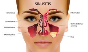 पीनस रोग - Sinus anatomy