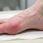 Swollen toe problem with uric acid
