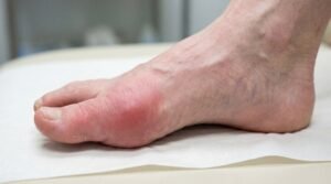 Swollen toe problem with uric acid